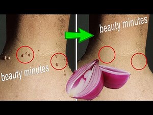 The most powerful natural home ingredients to remove warts forever