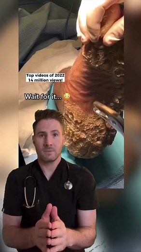 Worst Foot Calluses Ever! Shocking Footage