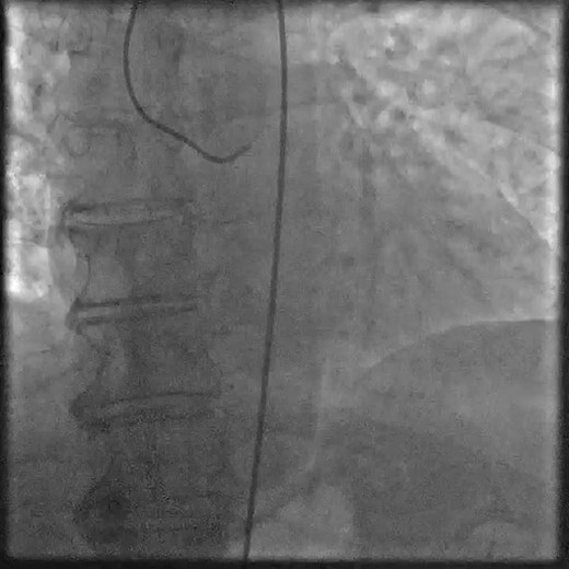 Infarto de miocardio transmural