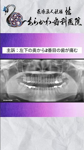 奥歯が痛い！?もしかしたら歯の神経の治療が必要かもよ！ #あらかわ歯科医院