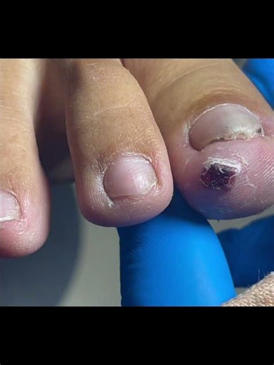 Amazing Toenail Trimming... #pedicure #toenails