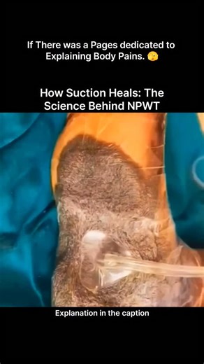 Explaining Biology on Instagram: "Negative Pressure Wound Therapy (NPWT) may look intense, but it’s one of the smartest healing techniques modern medicine has to offer. By applying controlled suction to a wound, NPWT gently removes excess fluid, reduces swelling, and lowers the risk of infection. This negative pressure also increases blood flow and oxygen delivery to the damaged tissue, which speeds up cell regeneration and helps new skin grow stronger and healthier. At a microscopic level, the 