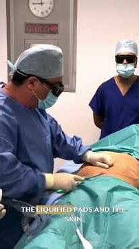 Abdomen Tightening: Cellulaze