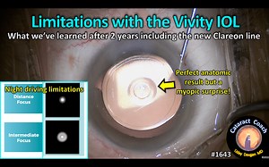 1643: limitations with the Vivity IOL