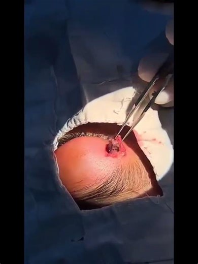 Foreign Body Removal (Eye Department Gujranwala Medical College)