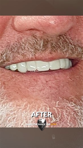 2K views · 12 reactions | This review is so straightforward! He's an honest guy who tells it like it is. Let us know your thoughts about this result! #bilveneer #dentures #instasmile #smiledesign #beforeafter #smilemakeover #smiletransformation #braces #adultbraces #newteeth #brighterimagelab #partialflipper #gapteeth #incisaledge #review #clientreview #honestreview #reviewer | Press On Veneers by Brighter Image Lab | Facebook