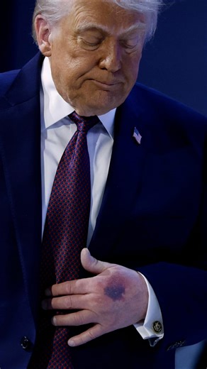 Trump explains reason behind heavy bruising on his hand