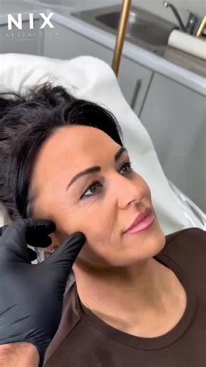 𝐍𝐈𝐗 𝐀𝐄𝐒𝐓𝐇𝐄𝐓𝐈𝐂𝐒 | 𝐀𝐃𝐕𝐀𝐍𝐂𝐄𝐃 𝐏𝐑𝐀𝐂𝐓𝐈𝐓𝐈𝐎𝐍𝐄𝐑 on Instagram: "COG threads are used to lift and reposition sagging tissue by stimulating collagen and restoring structural support. The goal is subtle lift improved definition and natural looking rejuvenation without adding volume. ✅ Immediate lift ✅ Improved jawline and midface support ✅ Gradual collagen stimulation 👉 DM “THREADS” to book at Nix Aesthetics Swansea #nixaesthetics #cogthreads #threadliftuk #faciallifting #no