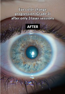 Thanks to the continuous improvement of our laser technology, we achieve visible results in fewer sessions; this is a Grade 3 case with a noticeable change in just three phases 🚀#eyecolorchange #lasereyetreatment #ocularaesthetics #medicalaesthetics #aestheticmedicine