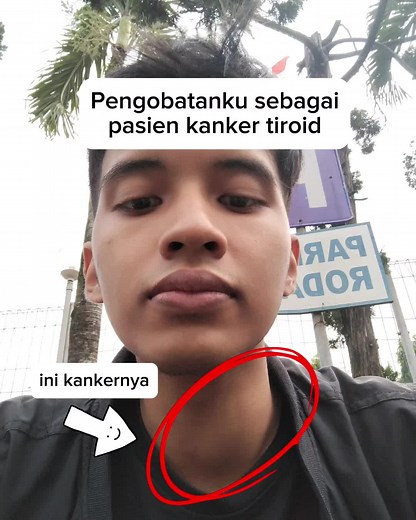 Berikut ini adalah tahapan-tahapan yang kualami selama menjalankan pengobatan kanker tiroid. 1. Operasi tiroid, pengangkatan keseluruhan tiroid atau biasa disebut tiroidektomi diperlukan utk mengangkat tumor yg ada. 2. Minum hormon, hormon diperlukan untuk menekan sel2 kanker dan sebagai pengganti fungsi tiroid 3. Ablasi, atau biasa disebut radioactive iodine therapy diperlukan utk menghancurkan sisa jaringan tiroid fungsional/sel kanker 4. Olahraga & hidup sehat, because why not? 🤷‍♂️ Jadi pen