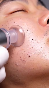 Most Satisfying Blackhead Vacuum Extraction Ever! (Ultra Macro) 識✨ | Fitness club | Facebook
