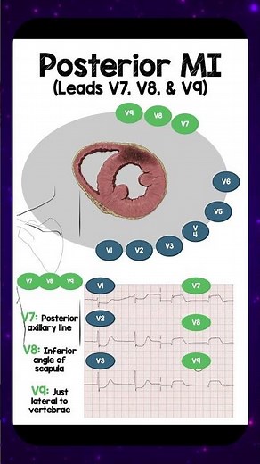 Posterior MI: Leads V7, V8, & V9 #REBELEM #ECG #EKG #PosteriorMI