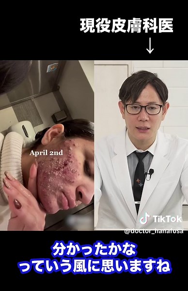 イソトレチノインを服用したニキビ治療の経過と皮膚科医の解説