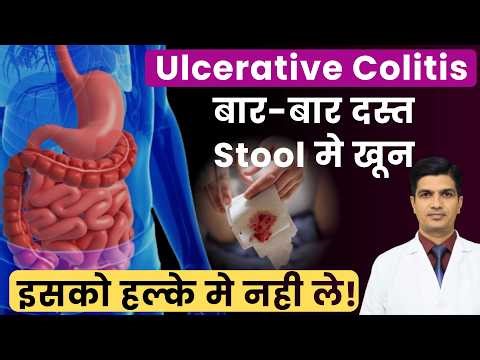 Ulcerative colitis in hindi | आंतो की गम्भीर बीमारी | Ulcerative colitis treatment