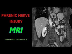PHRENIC NERVE INJURY MRI - Paralyzed Diaphragm - Eventration
