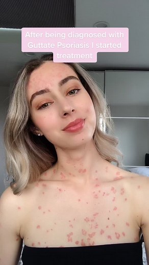 Effective Psoriasis Treatment with UVB Phototherapy and PUVA