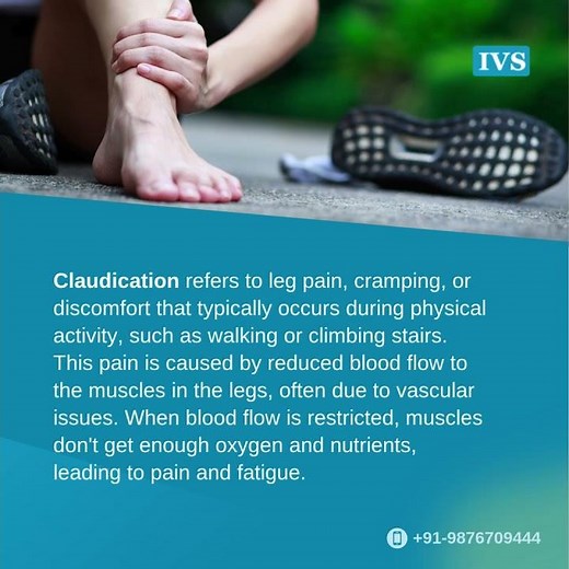 What is Claudication - Understanding Leg Pain and Vascular Health