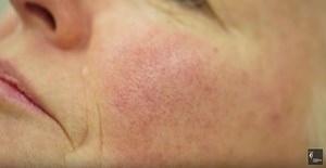 Rosacea (Facial Redness) & Capillaries