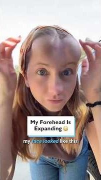 My Forehead Is Expanding 😨 👀