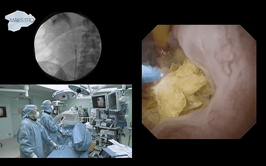 Operasi URS (Ureteroskopi) untuk Batu Ginjal dan Saluran Kemih - dr. Andika Afriansyah, Sp. U