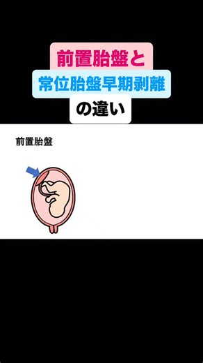 たばえもんナース塾(You Tuber) | 前置胎盤と常位胎盤早期剥離の違い #看護学生 #看護師国家試験 #看護学生さんと繋がりたい | Instagram