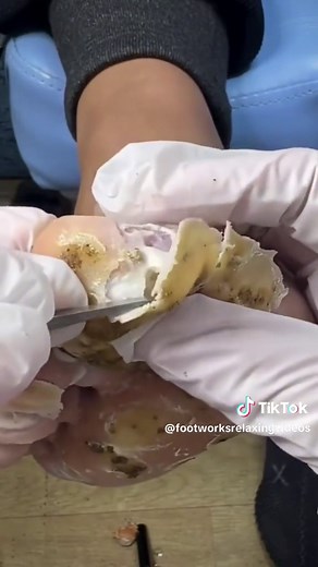 A provolone flavored cheese feet 👣 #footpain #fyp #viralvideo #satisfying #callusremoval #painful #podiatry #satisfyingvideo #myfootarekillingme #callus #trendingvideo #calluses #healthyfeetpodiatry #pedicure #crackedfeet @FootWorks Relaxing