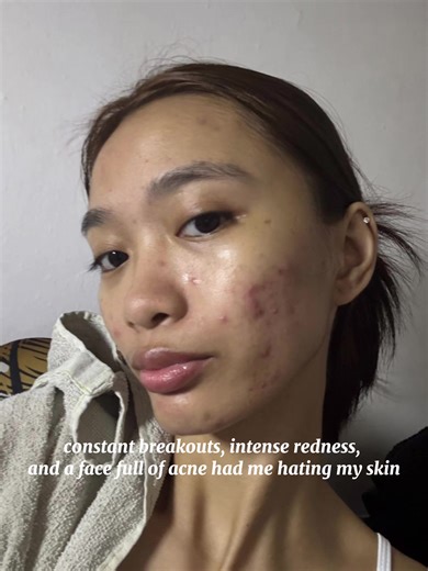 My Acne Journey: From Struggles to Triumph