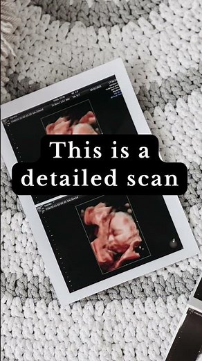 What Is an Anomaly Scan in Pregnancy? | Second Trimester Scan Explained Simply