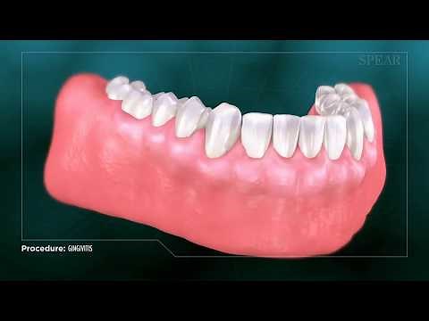 Gingivitis - Inflamed Gums