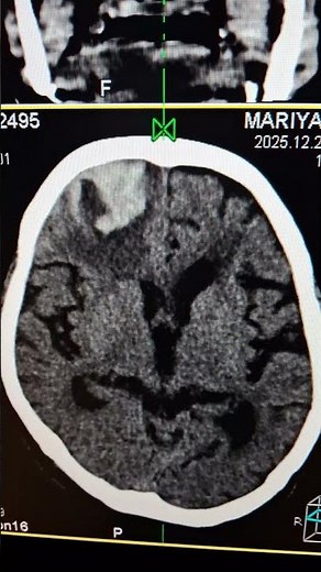 CT Brain. H/o Hypertension . Acute intraparenchymal hemorrhage.