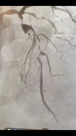 Heartvisual on Instagram: "🫀 Coronary Artery Aneurysm – LAD This angiogram demonstrates a focal aneurysmal dilatation of the Left Anterior Descending (LAD) artery, where the vessel diameter is abnormally enlarged compared to the adjacent normal segment. 🔍 Why it matters: • May lead to turbulent flow • Risk of thrombus formation. 💙 Follow heart visual for simple, visual cardiac education. #CoronaryAneurysm #LAD #HeartVisual #CardiologyEducation #Angiogram HeartHealth MedicalEducation CardioRee