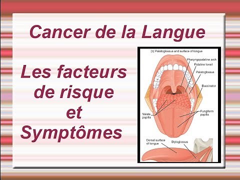Cancer de la langue : Facteurs de risque et Symptômes
