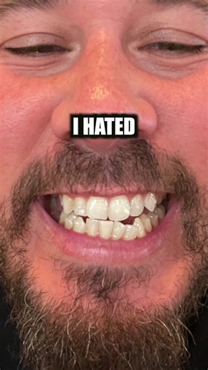 Straight Teeth Transformation: One Year Invisalign Timelapse