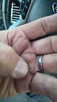 how to heal a blood blister quickly #bigdon