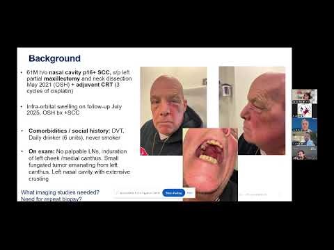 AHNS Fellows' Virtual Tumor Board: Sinonasal Cancer