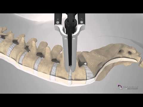 XLIF Patient Education Animation - Spanish