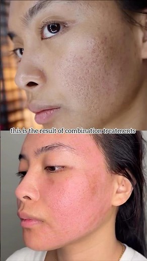 Acne and Scarring Combination Treatments Transformation - Kimberly