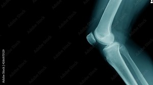 OA knee x-ray image footage with close up knee joint and red hight light, lateral view of OA knee with coppy space
