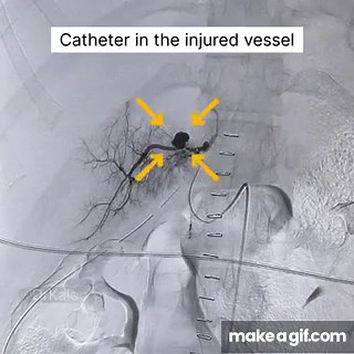 Embolisation for bleeding vessel in the Liver. on Make a GIF