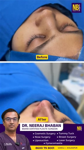 Neeraj Bhaban on Instagram: "Watch this Rhinoplasty (Nose Surgery) Before & After transformation performed by Dr. Neeraj Bhaban, showcasing natural and balanced results 👃✨ Rhinoplasty helps improve: ✔️ Nose shape & symmetry ✔️ Facial harmony ✔️ Breathing issues (if required) ✔️ Self-confidence At Nirmiti Plastic, Cosmetic & Laser Surgery Center, we focus on safe procedures, advanced techniques, and personalized care for every patient. 📌 Results may vary from patient to patient 📞 For consultat