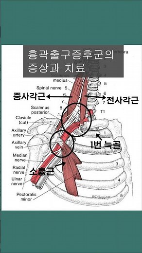S26 흉곽출구증후군의 증상과 치료[경추8번 신경근]