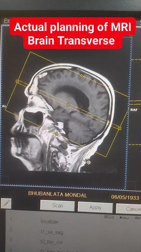 Actual correct planning for MRI Brain Transverse protocols #radiology #SiemensHealthineers #MRI #radiographer #radiography #radiologytechnologist #mriscan #CTscan #medicalimaging | Maruf Bhuiyan The Radiographer