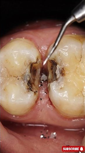 Tight Gap Rot – Severe interproximal decay spreading inward #dentaltransformation #dentist