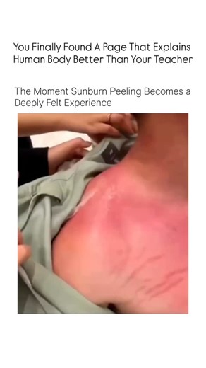 medical/health on Instagram: "​Witness the intense and highly dramatic process of peeling a severe sunburn. This video captures the raw pain and eventual relief as layers of damaged skin are removed, revealing the deeply red, fresh skin beneath. A vivid reminder to always wear sunscreen! #bio #biology #medical #viral #science"