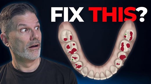 Understanding ClinCheck s Red Occlusion and Vertical Movements in Clear Aligners | Stephane Reinhardt posted on the topic | LinkedIn