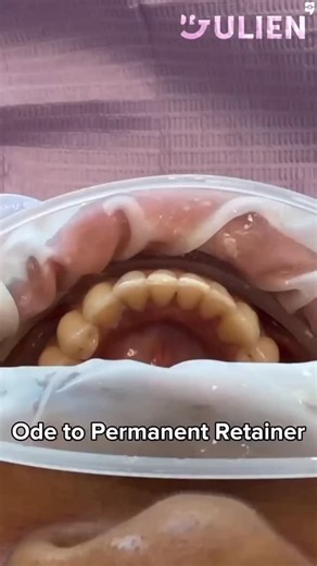 СООБЩЕСТВО ВРАЧЕЙ-ОРТОДОНТОВ🔝 | Автор @drjulienkim 🎵 Ode to the Permanent Retainer Etch. Bond. Flowable. Floss loops. Floss loops are used to hold the retainer wire... | Instagram