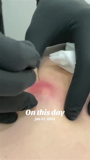 Understanding Skin Cysts: Causes and Treatments