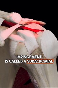 147K views · 1.1K reactions | ❓Surgery for shoulder impingement? This may surprise you. (Step-by-step plan  www.theptinitiative.com/shoulderprogram ) | The PT Initiative | Facebook