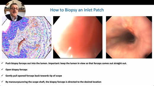Are you maximizing tissue yield during endoscopic biopsies? This video demonstrates a crucial technique for targeting lesions, especially those on the right side. • Advance biopsy forceps. • Retract towards endoscope tip. • Torque endoscope to target lesion. • Suction for maximal tissue. • Close forceps and biopsy. Mastering this approach optimizes diagnostic accuracy in daily practice. Watch the full lecture and explore our complete course library at EndoCollab.com. #gastroenterology #gastroent