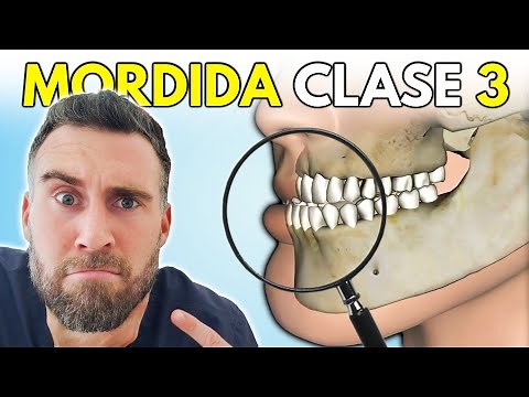 Class 3 Malocclusion 🚦 Treatment of Protruding Jaw | Underbite in Children and Adults